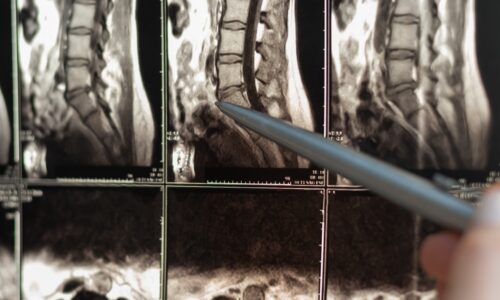 Herniated Discs from a Car Accident